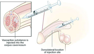 Day-dreaming-about-drugs-penile-injection1